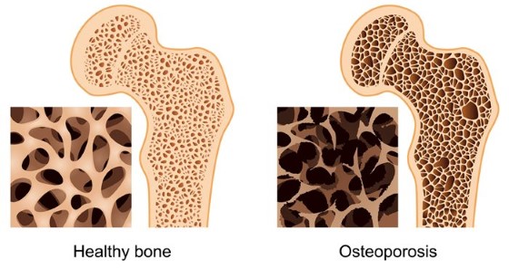 Porovnání hustoty zdravé kosti a kosti postižené ostoporózou, zdroj: msfocus.org